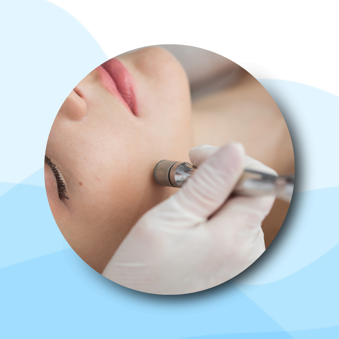 Microdermabrasion