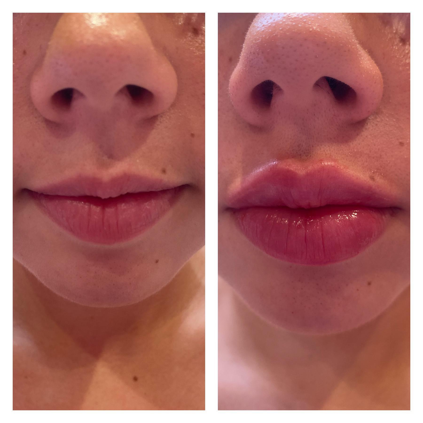 b12 injection face Methylcobalamin B12 injection