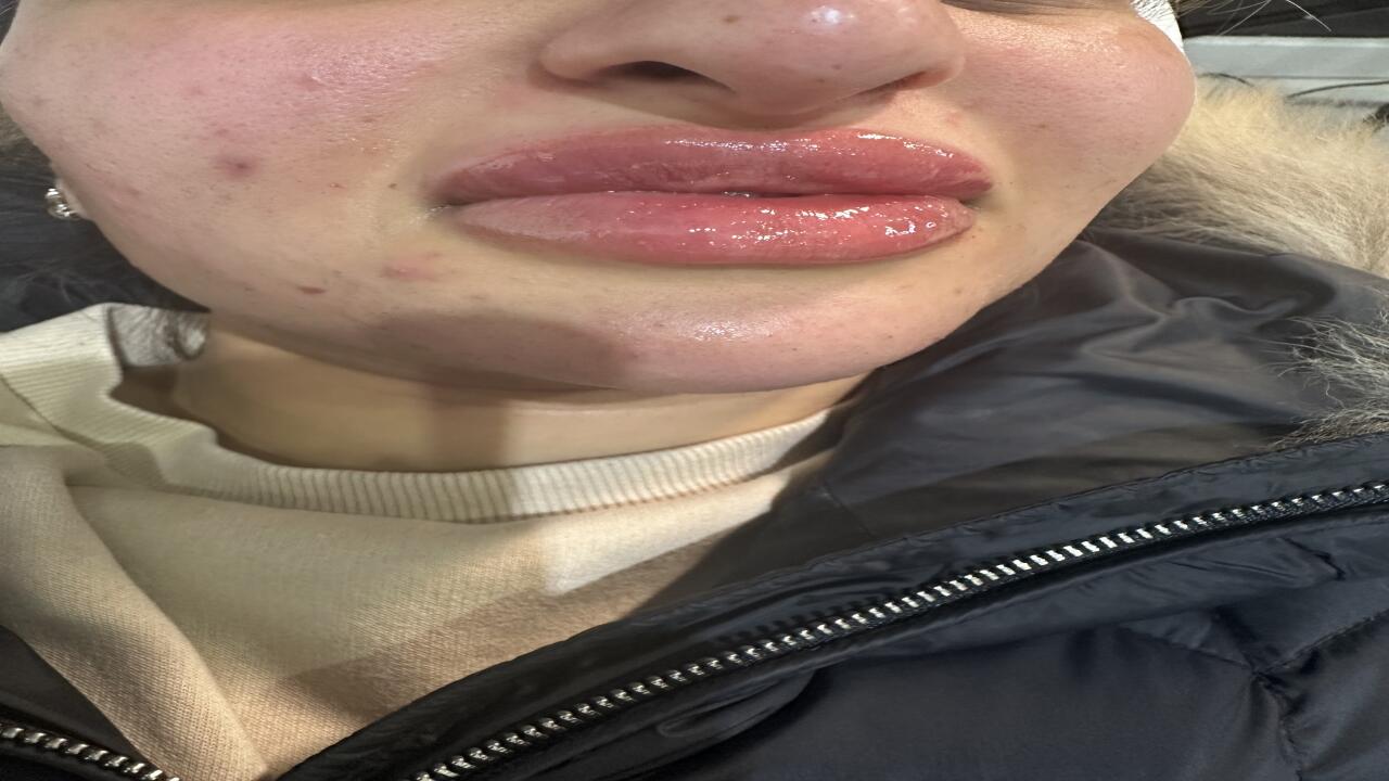 Lips2cheek aesthetics