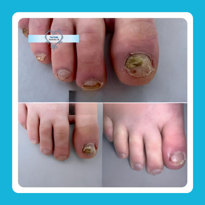 ND YAG Q-Switch Laser Machine – Tattoo Removal, Carbon Peel, Pigmentation & Fungal Nail (MHRA Registered + Level 5 Tattoo Removal Ofqual Training Included) - 2