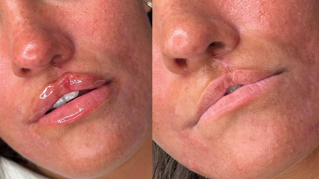 Cleft Lip & Scar Revision Filler Course Online