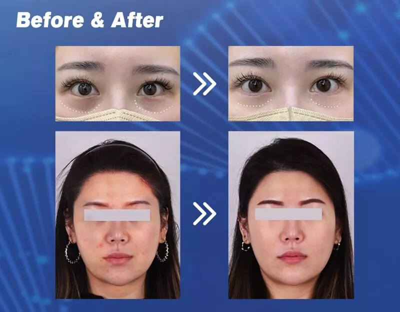 PNPURE™ Advanced Polynucleotides Filler - 2