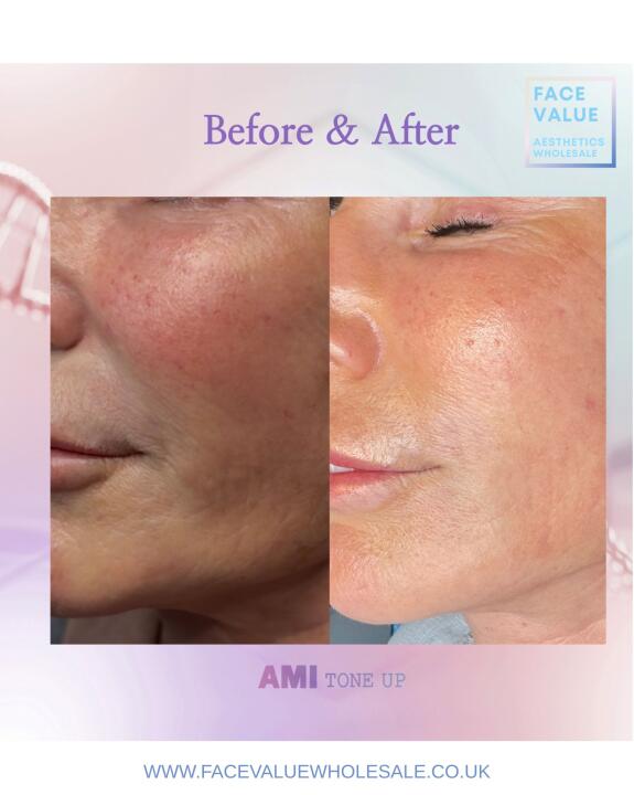 Ami tone up Skin booster with PN & EXOSOMES (6 x 5ml)
