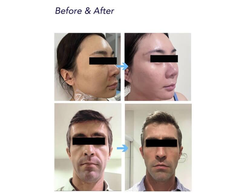 CHArmacy Calcium Hydroxyapatite (CaHA) Hydraulaunice Acid (HA) Filler - 3