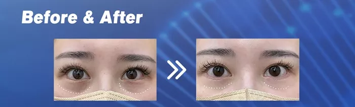 PNPURE™ NeoEye Polynucleotides for Under Eye - 2