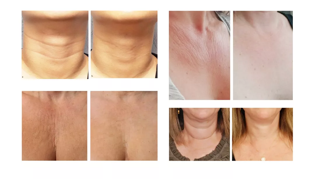 NutriDerm® HYLITE Skin Booster - Neck, Décolletage, Perioral - 3