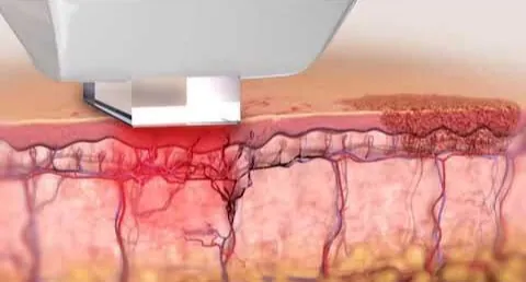 Laser and Intense Pulse Light – Core Of Knowledge (Online)