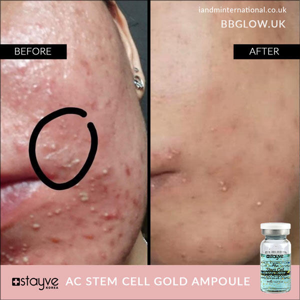 Stayve Acne Gold Ampoule (8ml x amps) - 5